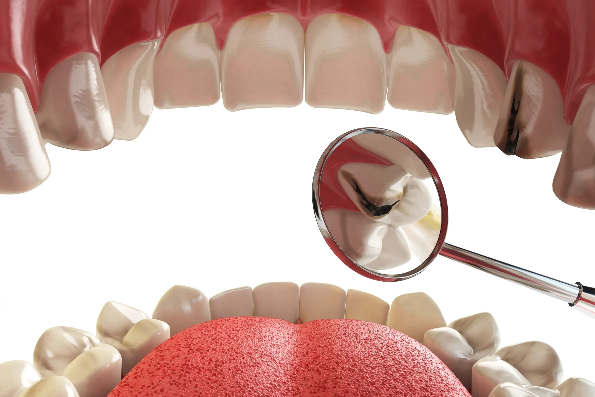 Dental Implants - Permanent Tooth Replacement Solution