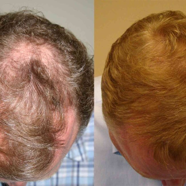 Best Hair Transplat Turkey